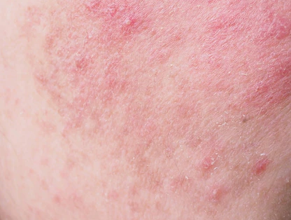 Skin Purging, What Is It and Why Does It Happen When Using Skincare